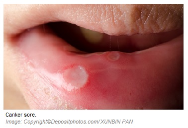 Canker sore 1 Canadian Academy of Sports Nutrition caasn