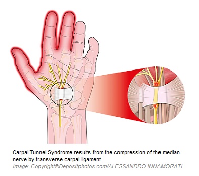 Carpal Tunnel Syndrome 1 Canadian Academy of Sports Nutrition caasn