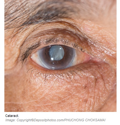 Cataract 1 Canadian Academy of Sports Nutrition caasn