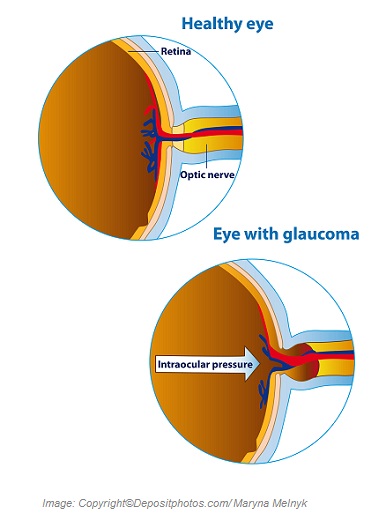 Glaucoma 1 Canadian Academy of Sports Nutrition caasn