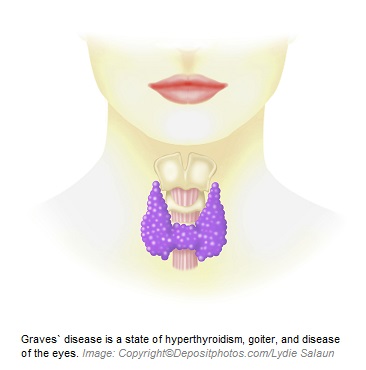 Graves disease 1 Canadian Academy of Sports Nutrition caasn