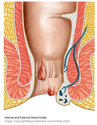 Hemorrhoids 1 Canadian Academy of Sports Nutrition caasn