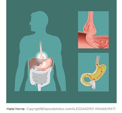 Hiatal hernia. Canadian Academy of Sports Nutrition caasn