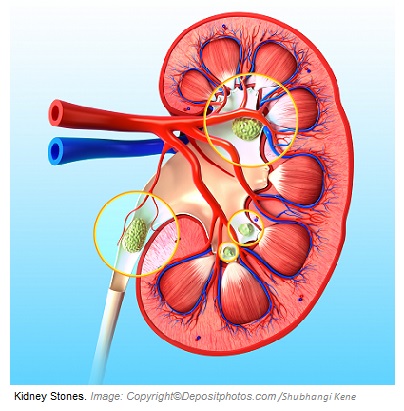 Kidney stones 1 Canadian Academy of Sports Nutrition caasn