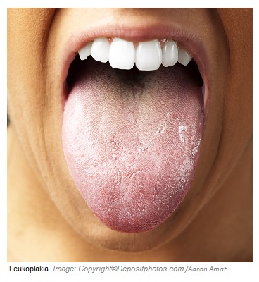 Leukoplakia 1 Canadian Academy of Sports Nutrition caasn