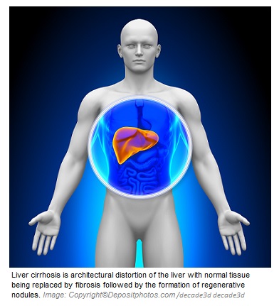 Liver cirrhosis 1 Canadian Academy of Sports Nutrition caasn