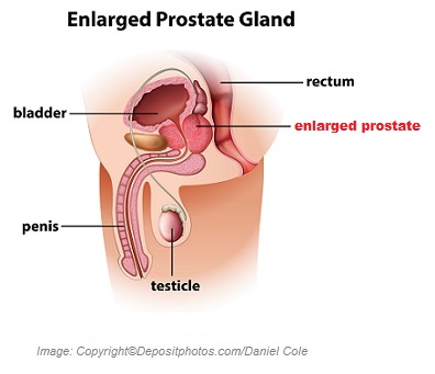 Prostate enlargement 1 Canadian Academy of Sports Nutrition caasn